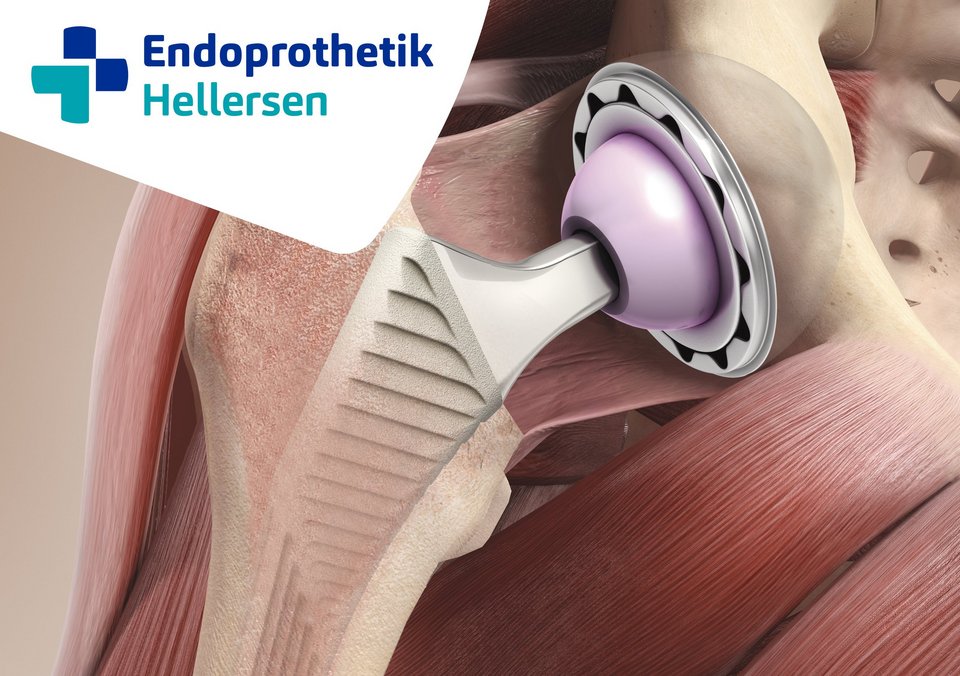 Endoprosthetics_Center_for_artificial_joint_surgery_hip_prosthesis_shoulder_prosthesis